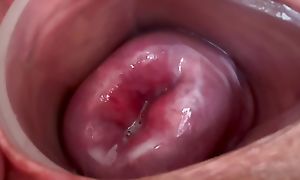 Compacted cervix on skid row bereft of dilating