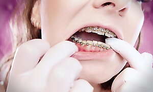ASMR: upgraded braces with chain-link rubber bands increased by nitrile gloves (Arya Grander)