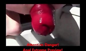Extreme anal fisting